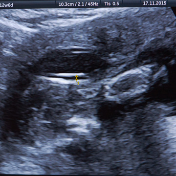 Expert in Ultrasound in Reproduction, Endometriosis, Pelvic Pain and Pelvic Floor