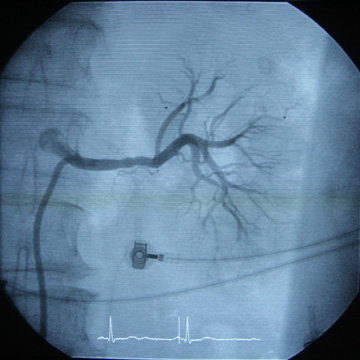Expert in Management of Venous Thromboembolic Disease and Anticoagulation in Atrial Fibrillation